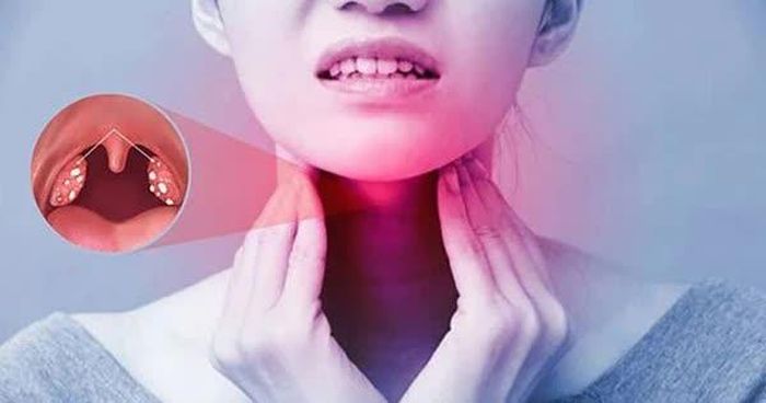 Đau họng có mủ có thể do vi khuẩn, nhưng có thể do nhiều nguyên nhân khác. Ảnh minh họa. 