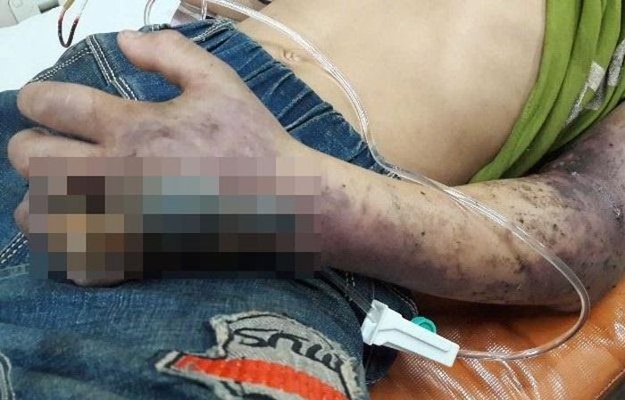  Chỉ vài giờ sau khi bị rắn độc cắn, người bệnh có thể rơi vào tình trạng nguy kịch. Ảnh: BSCC. 