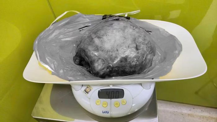 Khối u nặng 4kg. (Ảnh: BV cung cấp)