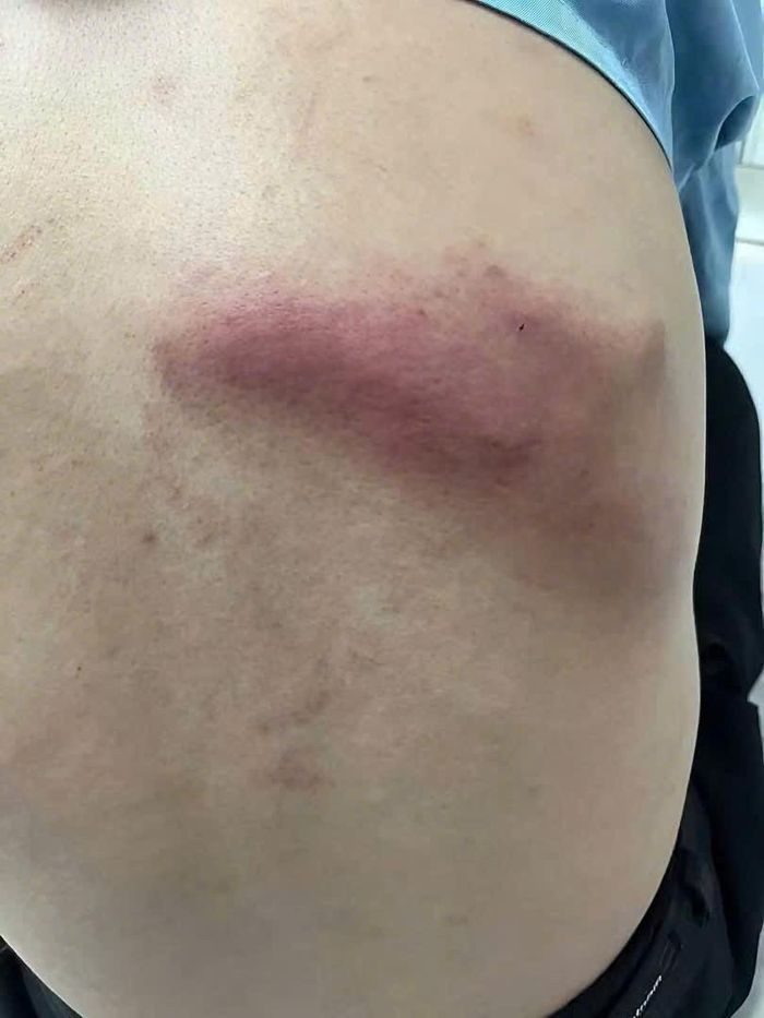 Bệnh giun rồng có thể gây đau đớn kéo dài.