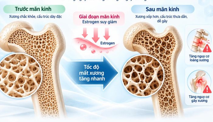 Thiếu hụt estrogen ở phụ nữ mãn kinh làm giảm mật độ xương, tăng nguy cơ loãng xương và gãy xương. Ảnh: Thanh Tâm