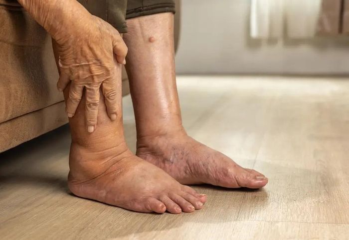  Sưng phù là dấu hiệu có thể xuất hiện khi thận không còn loại bỏ hiệu quả lượng muối và nước dư thừa. Ảnh: Adobe Stock. 