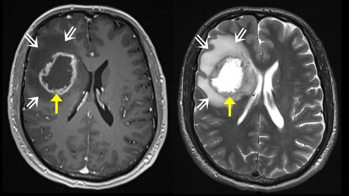 Glioblastoma là một trong những loại ung thư não ác tính và khó điều trị nhất.