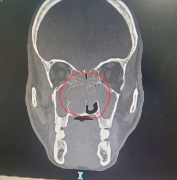 CT mũi xoang của bệnh nhân trước khi phẫu thuật