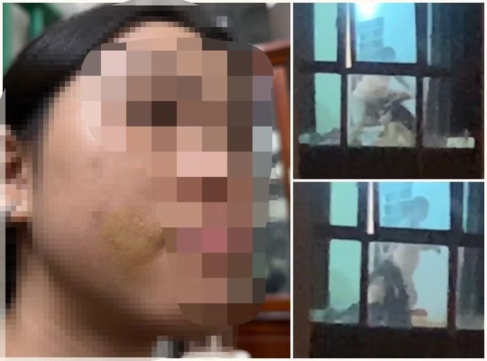 Vết bầm tím ở mặt bé gái.