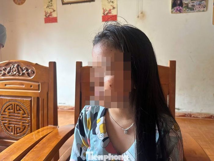 Nữ sinh N.T.U.T. bị túm tóc, bắt quỳ, dí điếu thuốc cháy vào mặt.