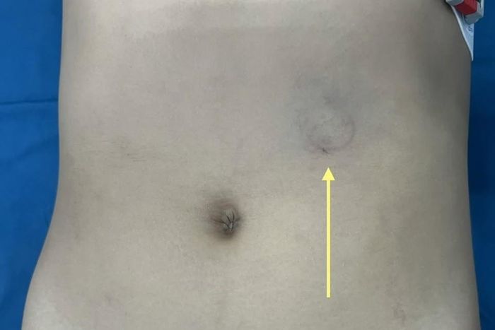 Vị trí vết bầm tím đường kính khoảng 2cm sau tai nạn. Ảnh: A.X