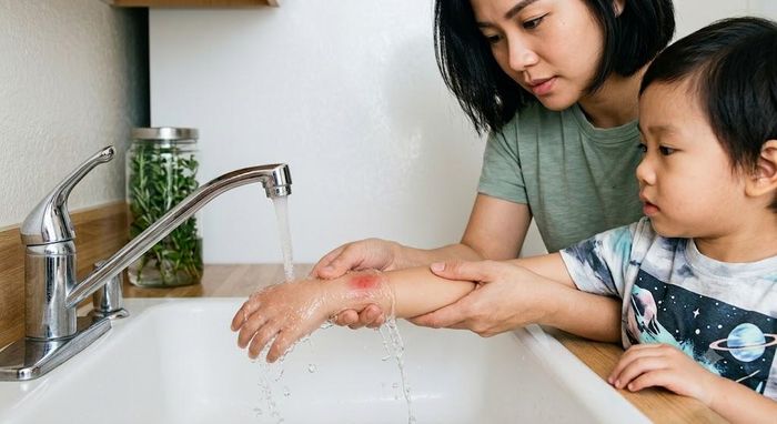 Khi trẻ bị bỏng nhiệt cần được làm mát dưới vòi nước sạch, mát.
