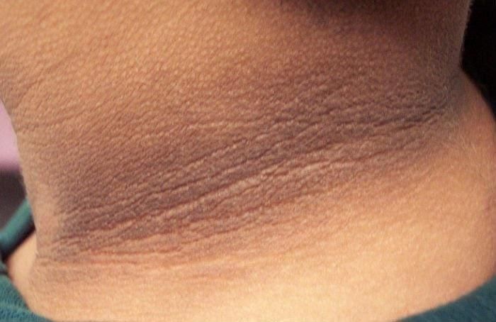 Gai đen (acanthosis nigricans) có thể là dấu hiệu cảnh báo tình trạng kháng insulin, thường biểu hiện bằng vùng da sẫm màu, dày và có bề mặt như nhung, nhất là ở cổ, nách hoặc bẹn.