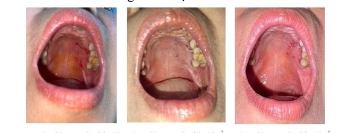 Hình ảnh tổn thương niêm mạc miệng trước và sau hai lần tiêm corticoid nội tổn thương. (Ảnh: BSCC)
