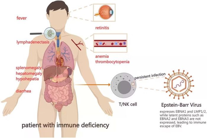 Virus EBV lây nhiễm vào cơ thể người, tạo thành nhiễm trùng tiềm ẩn. Khi chức năng miễn dịch của cơ thể bị suy giảm virus sinh sôi, dẫn đến hàng loạt bệnh.