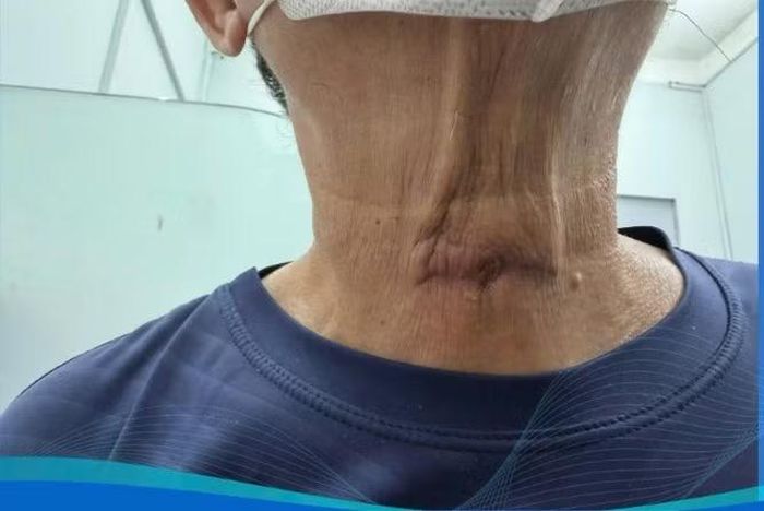 Vết thương đã lành sau phẫu thuật - Ảnh BVCC