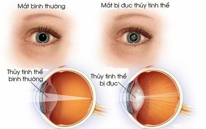 Người bị bệnh có cảm giác nhìn qua màng sương khói, mờ đục, nhìn có quầng, màu sắc kém sinh động. Ảnh minh họa.