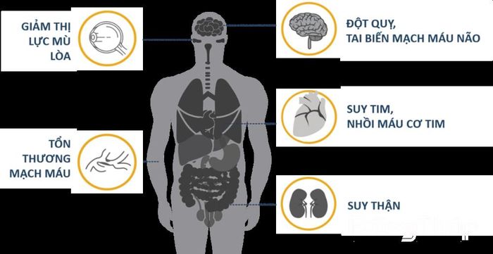 Một số biến chứng thường gặp của tăng huyết áp. Ảnh minh họa có sử dụng AI