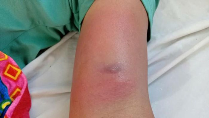 Người bệnh nổi các mụn nhọt tại bắp tay, vùng ngực và hông. Ảnh: CDC Thanh Hóa.