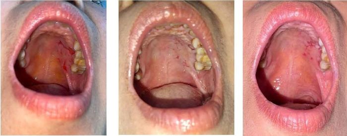Trước tiêm corticoid nội tổn thương (ngoài cùng bên trái), sau tiêm corticoid nội tổn thương lần 1 (ở giữa), sau tiêm corticoid nội tổn thương lần 2 (ngoài cùng bên phải). Ảnh: BVCC