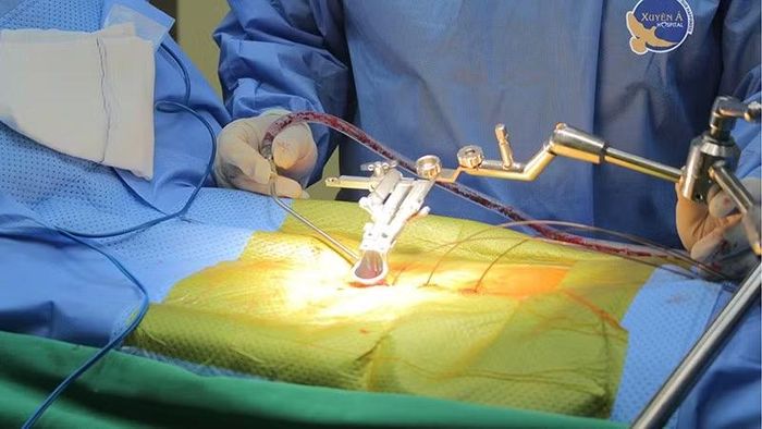 Thông qua các đường rạch da nhỏ chưa đầy 1,5cm, các vít chuyên dụng được đưa vào cuống đốt sống để cố định cột sống. (Ảnh: Bệnh viện cung cấp)