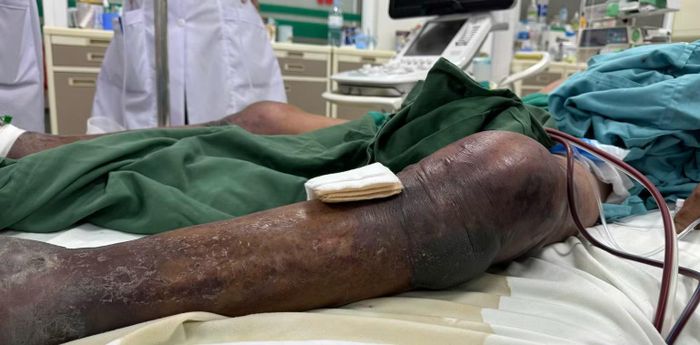 Nhiễm liên cầu lợn có thể diễn tiến rất nhanh, đặc biệt khi vi khuẩn xâm nhập vào máu gây nhiễm khuẩn huyết nặng.