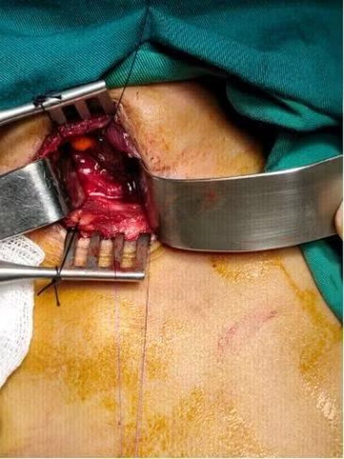 Hình ảnh các phẫu thuật viên đang cố gắng tiếp cận, lấy dị vật ra khỏi thực quản bệnh nhi - Ảnh BVCC