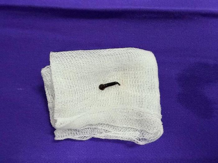 Qua nội soi, bác sĩ phát hiện con đỉa bám tại vùng thanh môn, nơi có hai dây thanh và khe cho không khí đi qua khi hô hấp. Đây là vị trí cần đặc biệt lưu ý bởi nếu dị vật phát triển hoặc di động làm hẹp đường thở, người bệnh có thể gặp nguy hiểm. Ảnh: BVCC