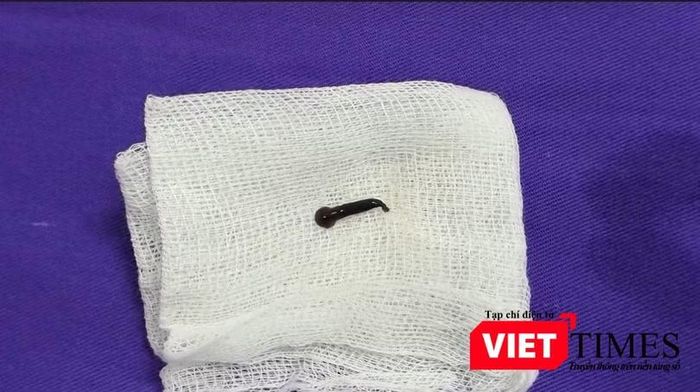 Con đỉa được lấy ra. Ảnh: Phương Anh.