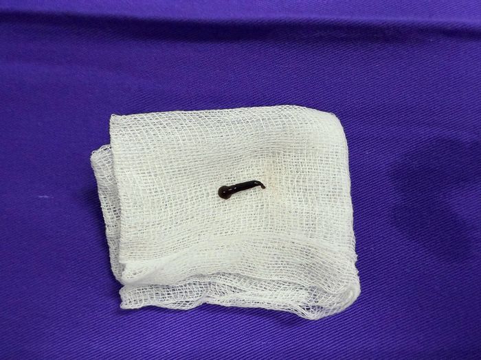 Bác sĩ Bệnh viện Tai Mũi Họng Trung ương đã phát hiện và lấy ra con đỉa sống trong thanh quản của bệnh nhân.