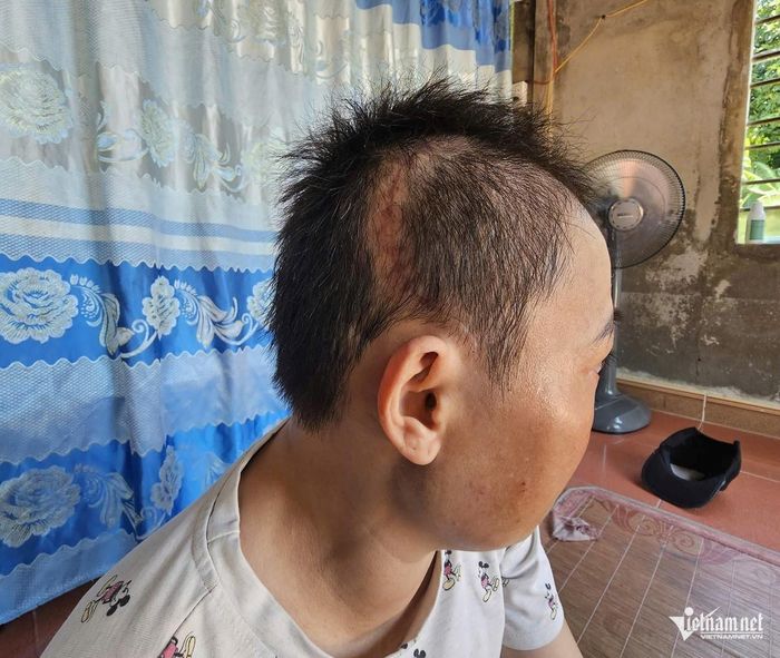 Chị Điếp đã được phẫu thuật lấy khối u làm xét nghiệm giải phẫu bệnh, kết quả xác định u màng não độ 2 (WHO). Ảnh: Hải Sâm