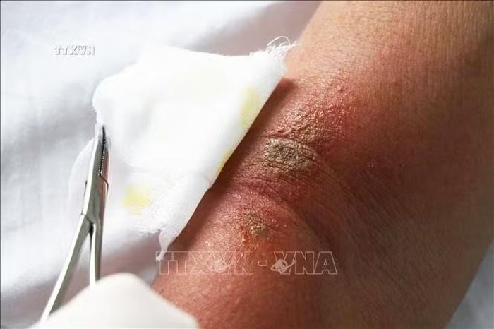 Chăm sóc vết thương viêm da tiếp xúc do kiến ba khoang.