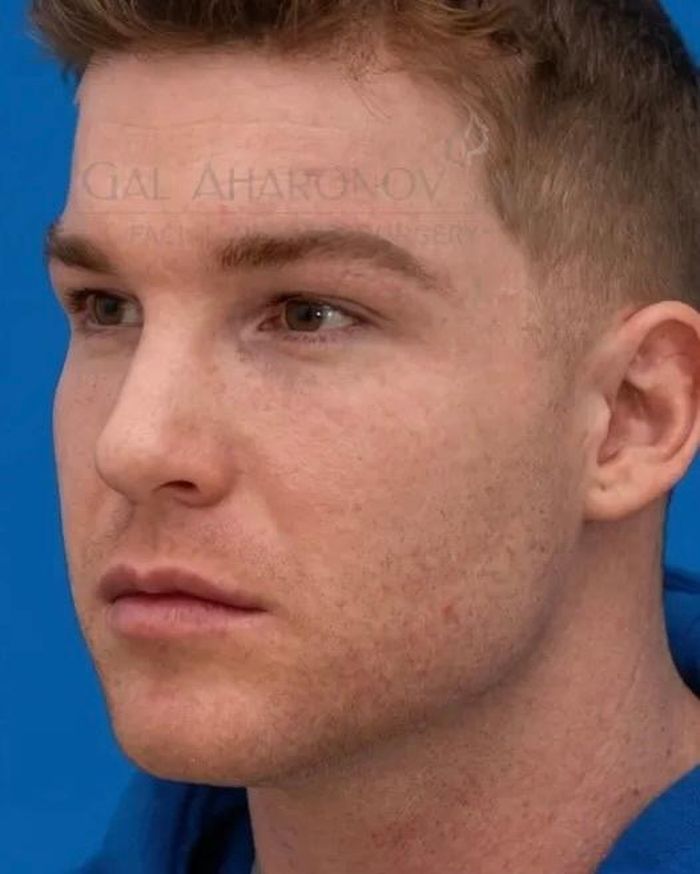 Hình ảnh trước (trái) và sau (phải) một ca phẫu thuật tạo dáng “mắt săn mồi” tại Mỹ. Ảnh: @drgalmd.