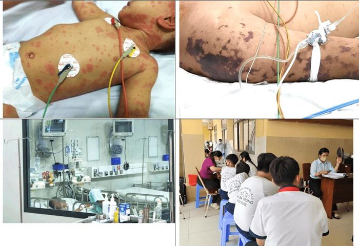 Bộ Y tế phát đi khuyến cáo khẩn phòng chống bệnh não mô cầu sau chùm ca bệnh tại TP. HCM (Ảnh Bộ Y tế)
