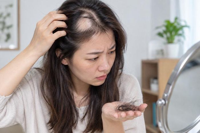 Rụng tóc từng mảng là bệnh lý thường liên quan đến cơ chế tự miễn. Ảnh minh họa AI.