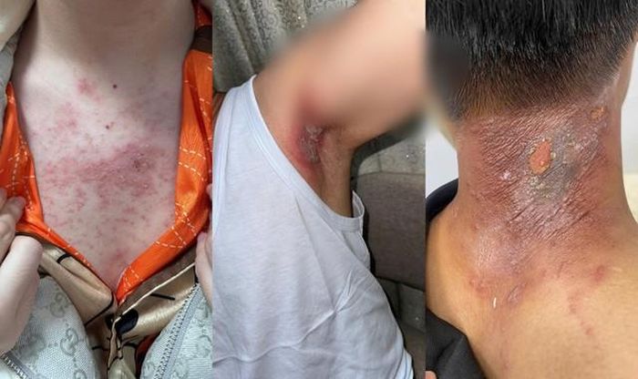 Nhiều người dân Hà Nội bị viêm da, bỏng rát và nổi mụn nước do tiếp xúc với kiến ba khoang (Ảnh: BSCC).