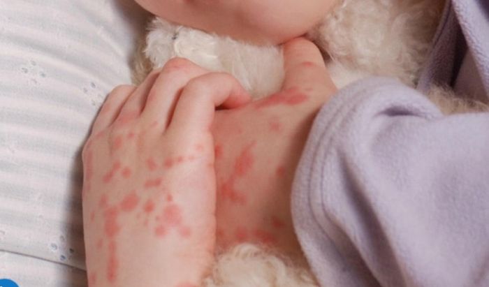 Đám xuất huyết trên da là dấu hiệu bệnh não mô cầu.