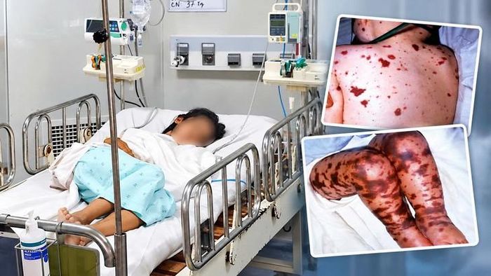 Bệnh não mô cầu đặc trưng với các vết tử ban. Ảnh: P.T.