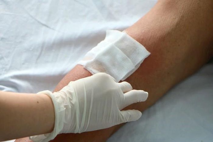Nhân viên y tế xử lý tổn thương da do kiến ba khoang cho người bệnh. Ảnh: PV.