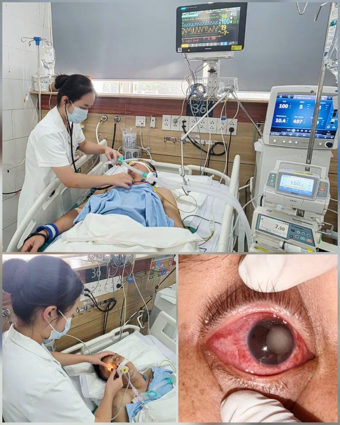 Nam người bệnh 37 tuổi bị bỏng giác mạc sau khi tiếp xúc với khí clo.