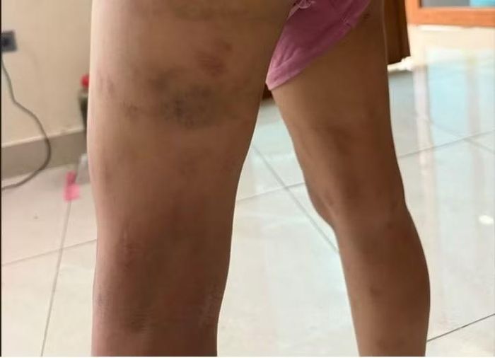Các vết bầm tím trên cơ thể các cháu nhỏ do bị chính bố ruột hành hạ, ngược đãi