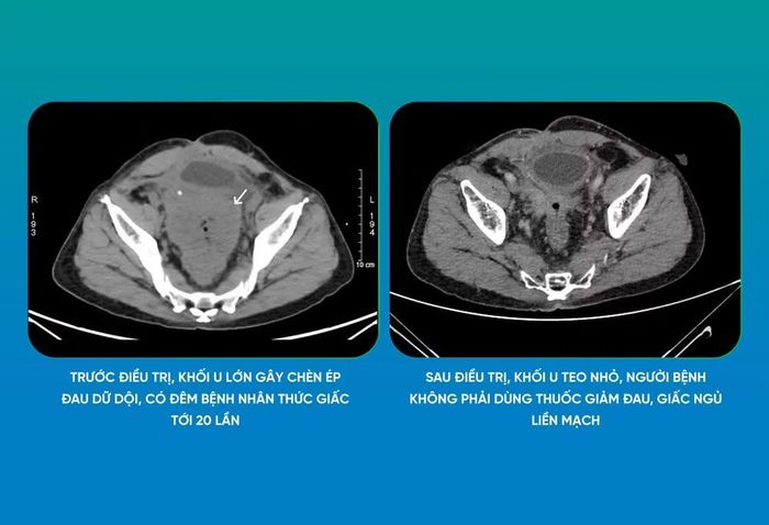 Túi tinh nằm sâu trong tiểu khung, phía sau bàng quang và gần tuyến tiền liệt. Khi khối u phát triển, vị trí giải phẫu này khiến tổn thương có thể xâm lấn các cơ quan lân cận, đồng thời gây khó khăn cho việc phẫu thuật. Ảnh: Diễm Ly