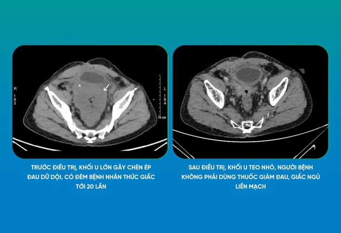 Khối u thu nhỏ rõ rệt sau 28 buổi xạ trị thích ứng phối hợp hóa trị (Ảnh: BVCC)