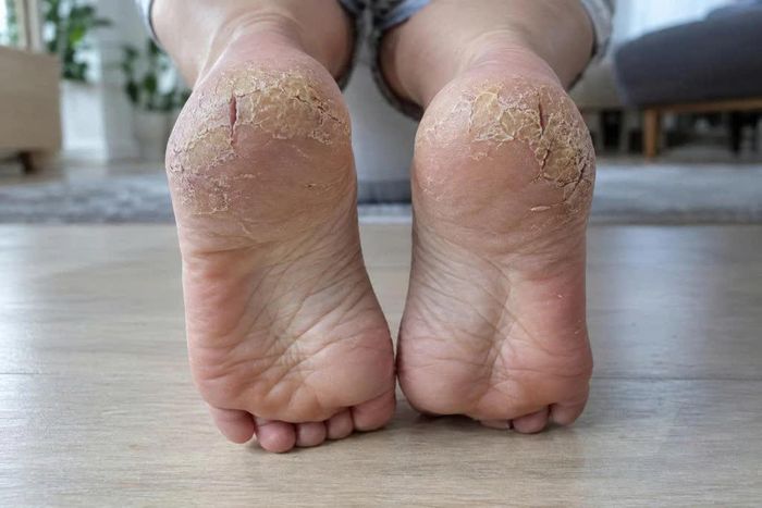 Gót chân nứt nẻ do da khô trong mùa đông, cần được dưỡng ẩm thường xuyên để hạn chế tình trạng khô ráp, bong tróc.