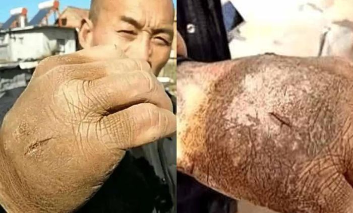 Ông Trần Văn Chúc tập Thiết Sa Chưởng tới mức bàn tay to ra và có cả sẹo