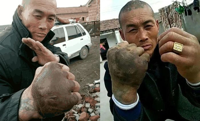 Bàn tay phải của Trần Văn Chúc biến dạng, đổi màu do tập Thiết Sa Chưởng trong hơn 20 năm