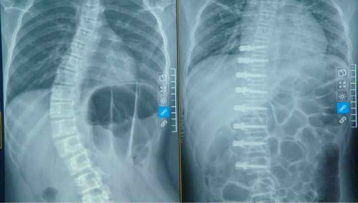 Góc vẹo của bệnh nhi giảm từ 48 độ xuống còn 10 độ, đạt mức nắn thẳng gần 80%.
