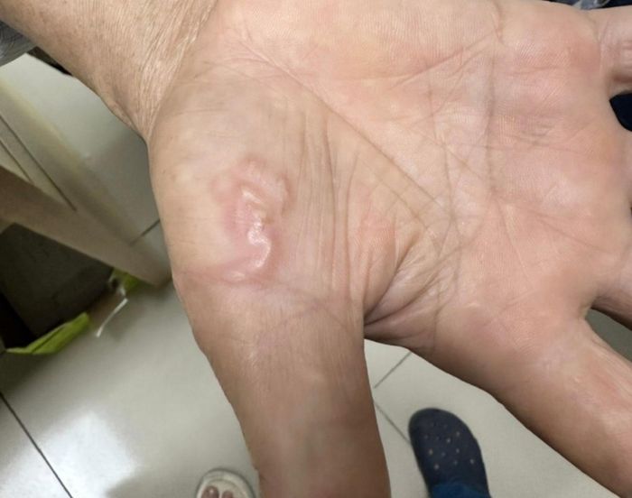  Nguy cơ nhiễm ký sinh trùng từ các bệnh nhiệt đới bị lãng quên. Ảnh minh họa 