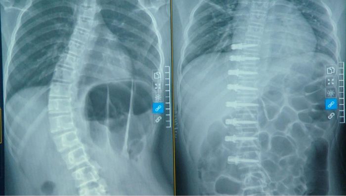 Phim chụp Xquang hình trước và sau phẫu thuật nắn chỉnh cong vẹo cột sống không ghép xương VBT. Ảnh: BVCC