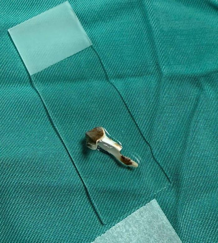 Dị vật được lấy ra, giải phóng tình trạng bít tắc đường thở cho trẻ. Ảnh: BVCC 