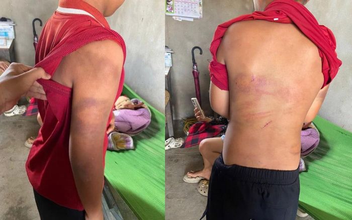 Ngày 8/6. người thân phát hiện trên cơ thể bé U chằng chịt vết bầm dập nên đã làm đơn tố cáo gửi Công an xã Quỳnh Anh, tỉnh Nghệ An