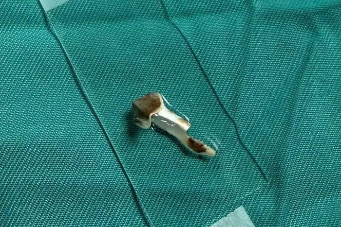 Dị vật được lấy ra - Ảnh BVCC