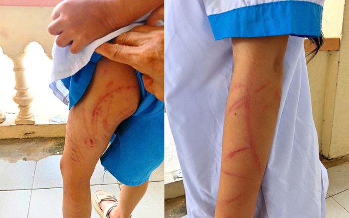 Chân và tay của bé N.A. chằng chịt vết bầm tím nghi do bị mợ bạo hành bằng dây điện.