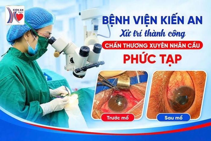 Hình ảnh phẫu thuật cho bệnh nhân bị mảnh bát vỡ bắn vào mắt, xuyên nhãn cầu. Ảnh: BVKA